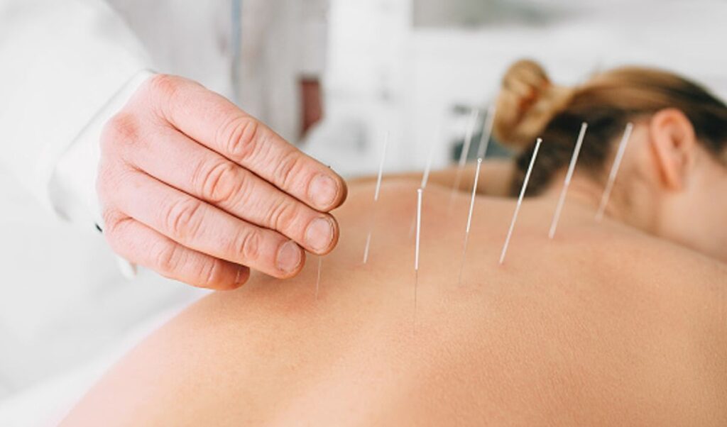 NYC acupuncture