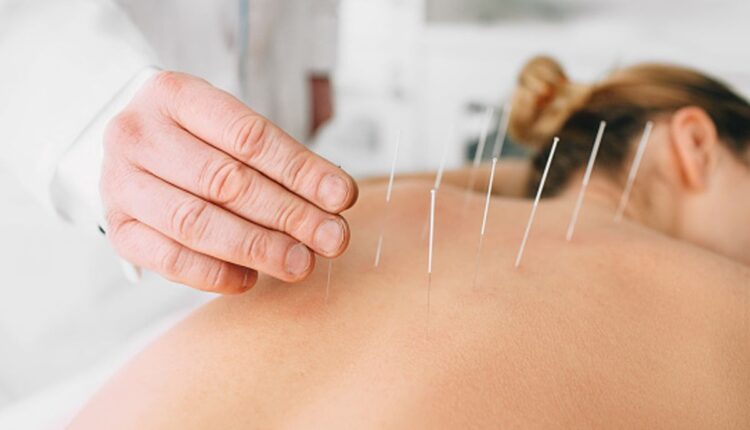 NYC acupuncture