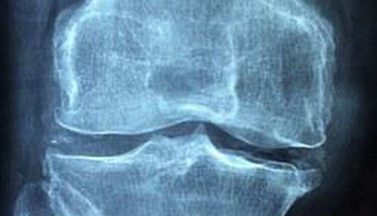 Arthritis, Inflammation, Joint Pain