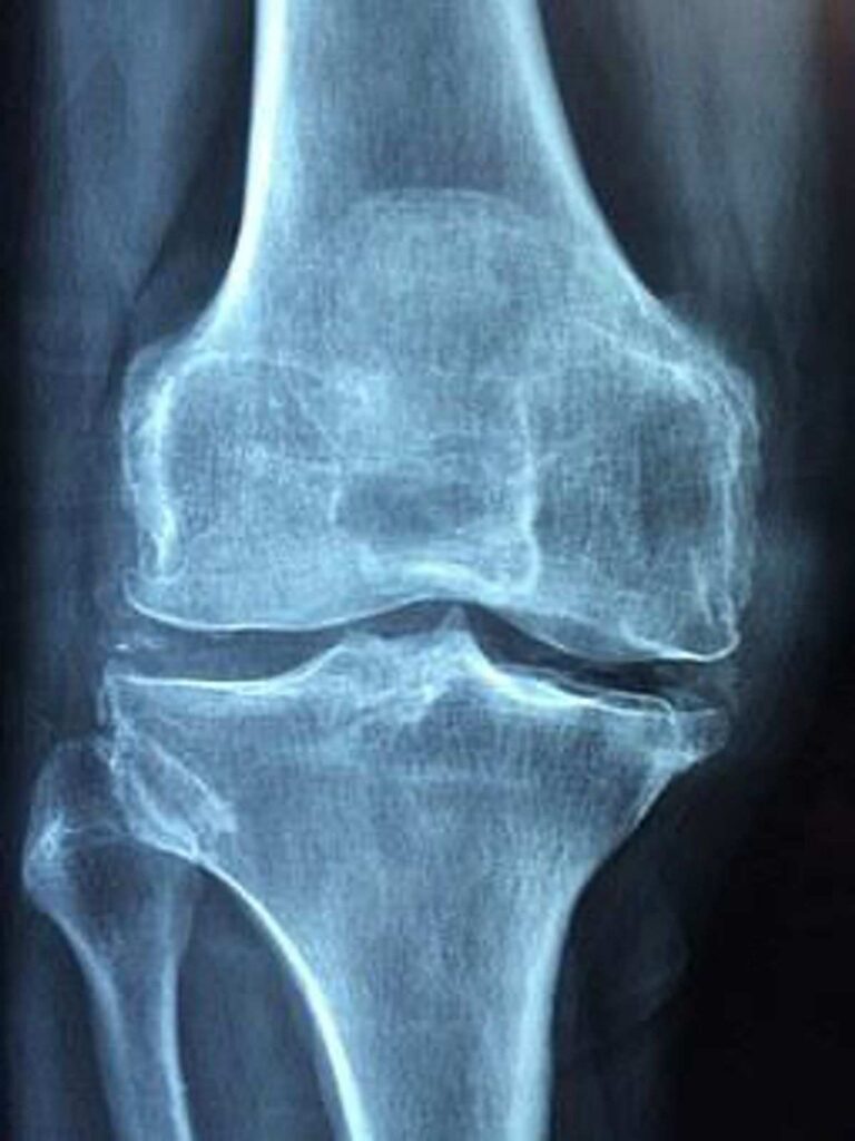 Arthritis, Inflammation, Joint Pain