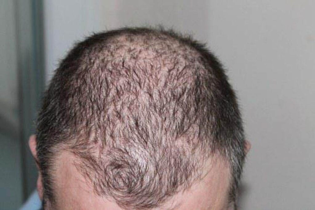 Male Hair Loss Causes