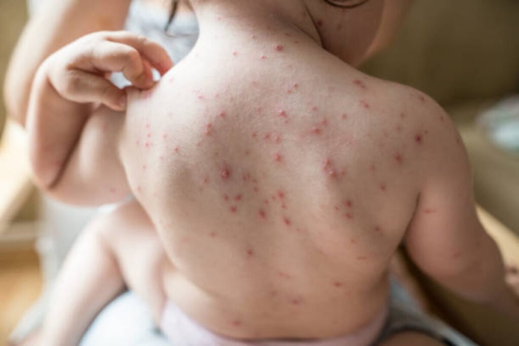 chicken pox
