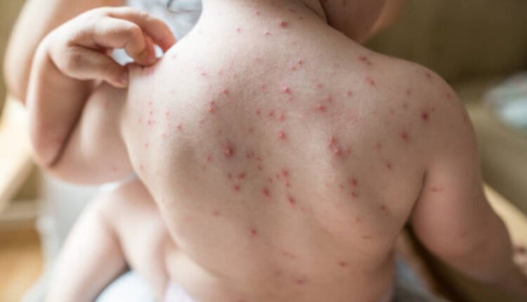 chicken pox