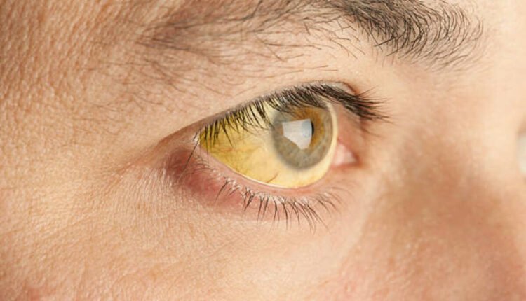 jaundice