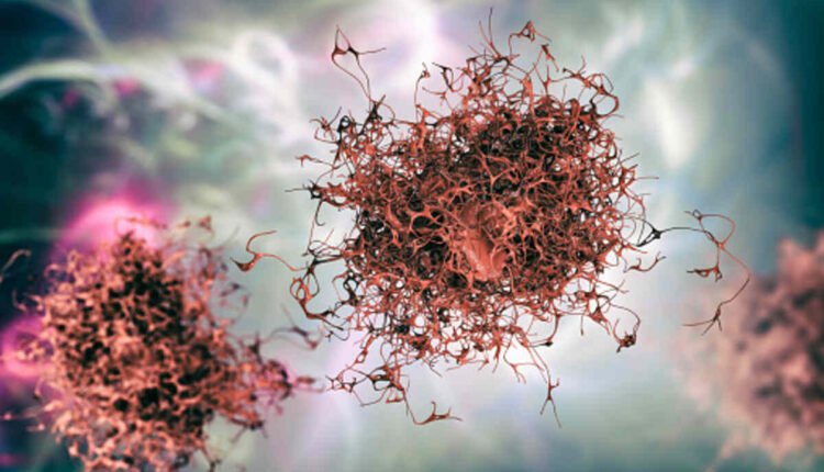 myeloma