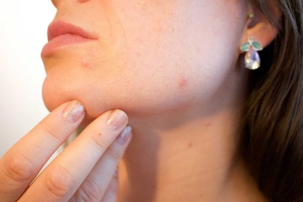 How to Get Rid of Blackheads