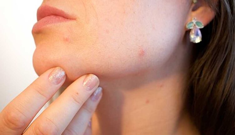 How to Get Rid of Blackheads