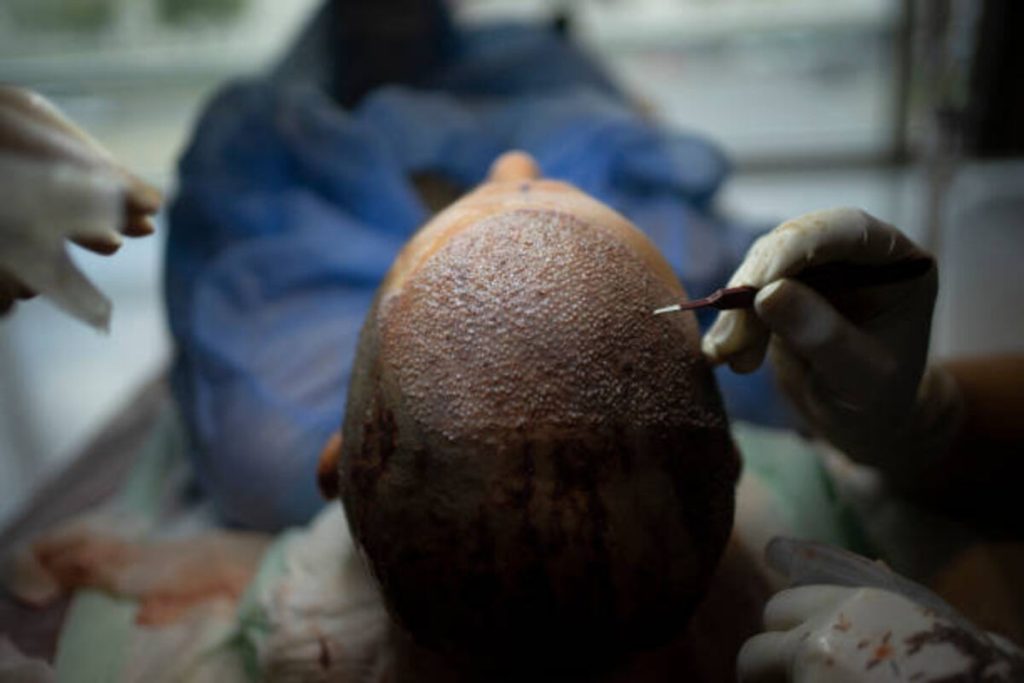 Follicular unit extraction clinic in ARIZONA